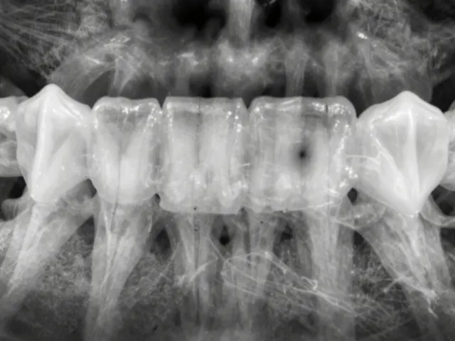 Jak vypadá zubní kaz na rentgenu? Vizualizace a jak ho dentista rozpozná