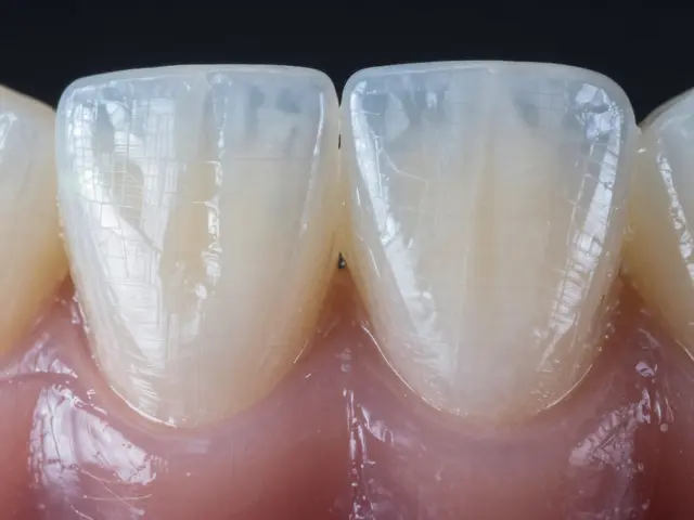 Budoucí fázy zubních fazet: Nové technologie a materiály pro krásný úsměv