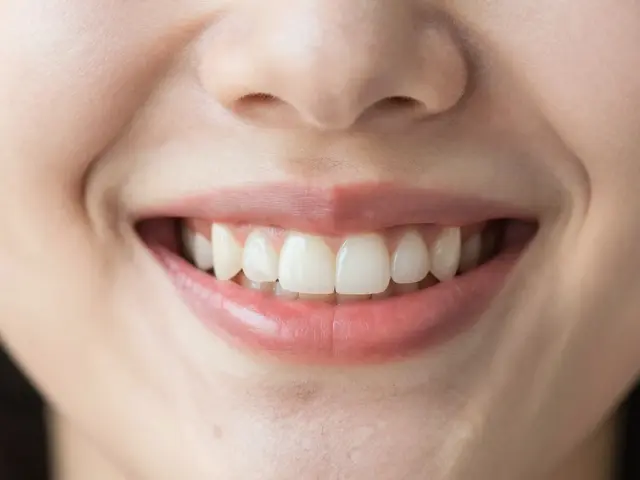 Křivé zuby: Kdy jsou jen estetickou vadou a kdy vyžadují léčbu?